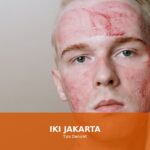 Ilustrasi cara mengatasi luka bakar dengan tips darurat