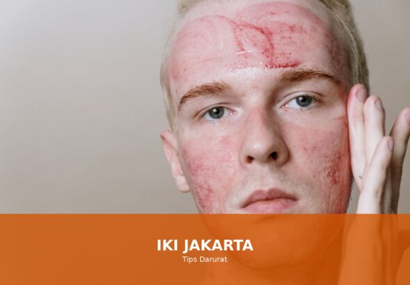 Ilustrasi cara mengatasi luka bakar dengan tips darurat