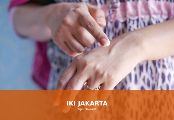 Ilustrasi tips mengatasi luka bakar secara darurat.